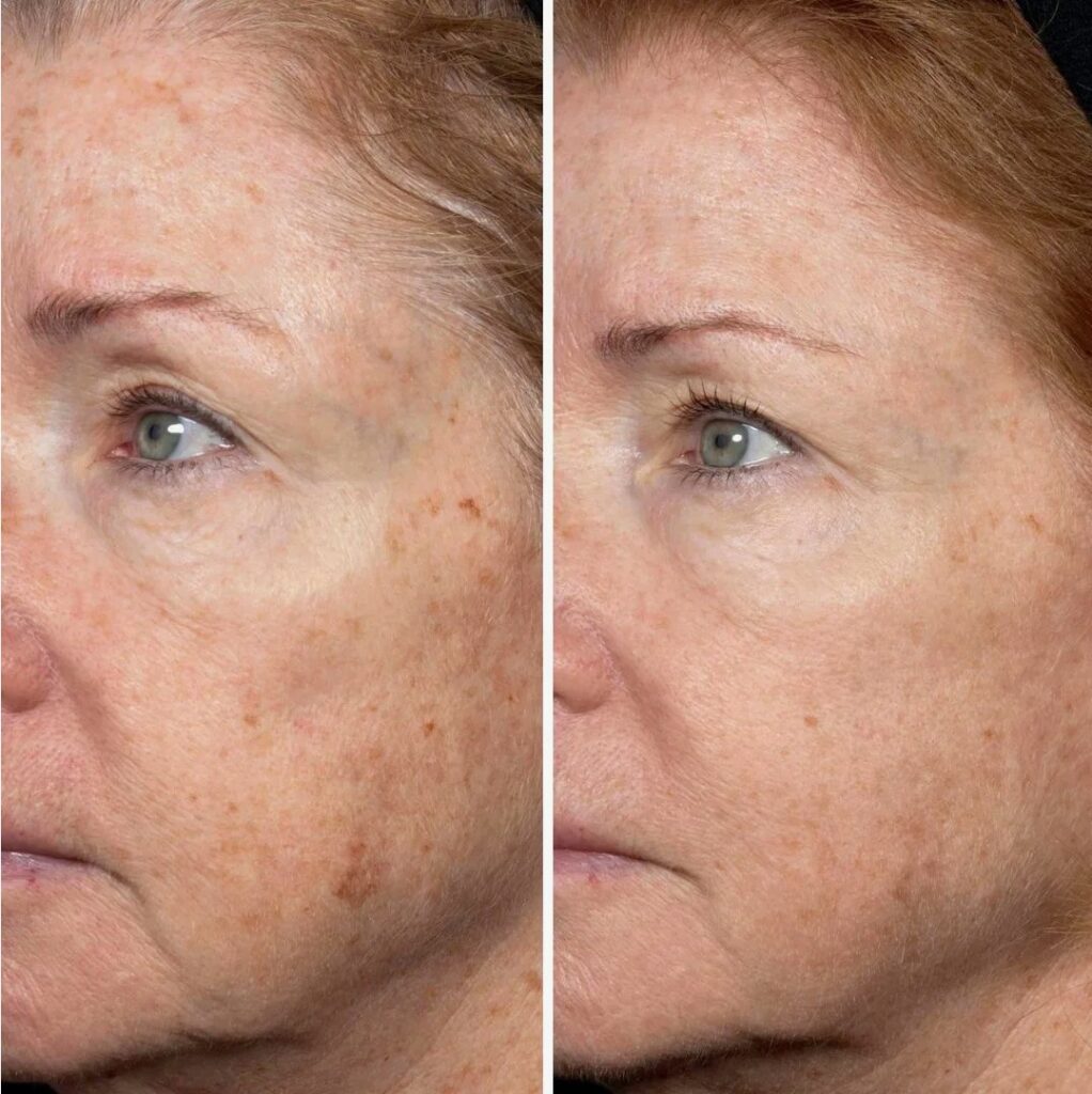 Forma-RF-London-Advanced-Radiofrequency-Skin-Tightening-Treatment