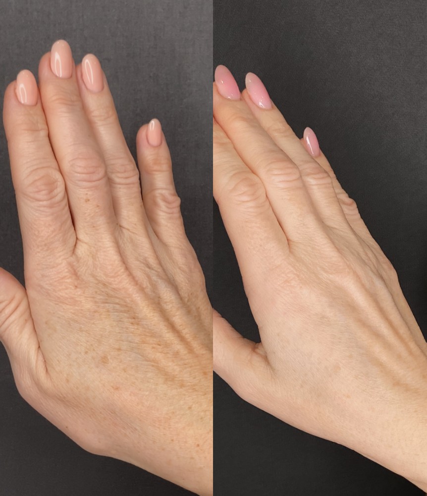Hand-Rejuvenation-Treatments-in-London