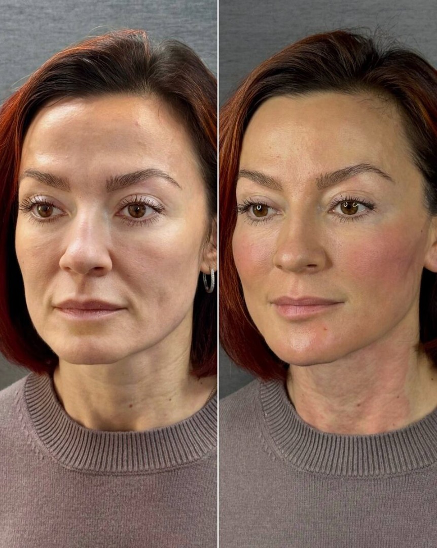 Hyamax-Filler-in--London