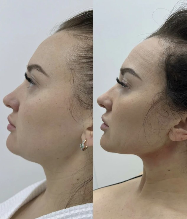 Jawline-Fillers-At-The-London-Clinic