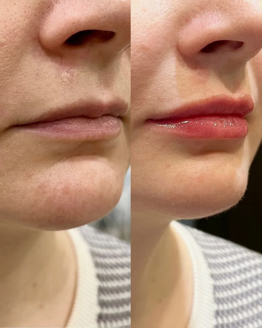 Kairax-Filler-in-London