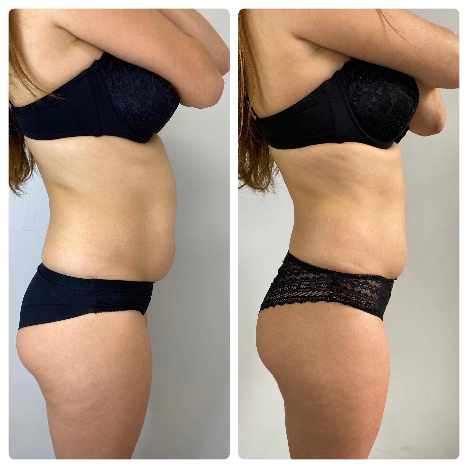 Lemon-Bottle-Fat-Dissolving