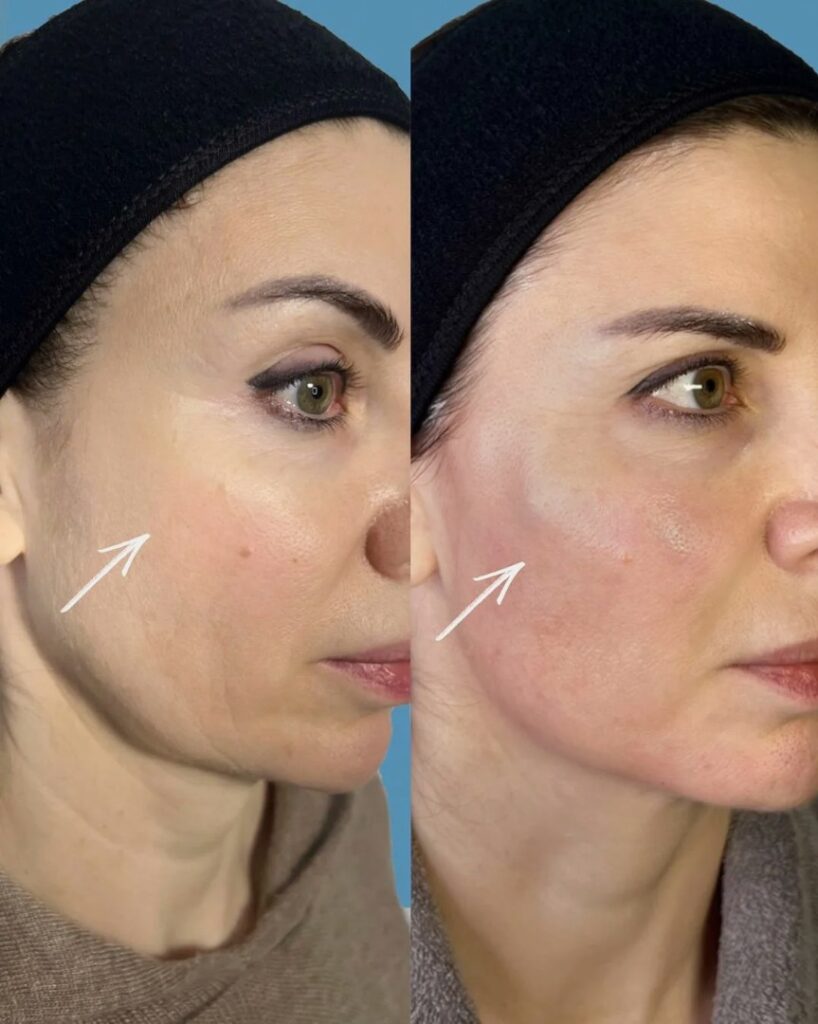 Lumecca-IPL-London-Advanced-Skin-Rejuvenation-Treatment
