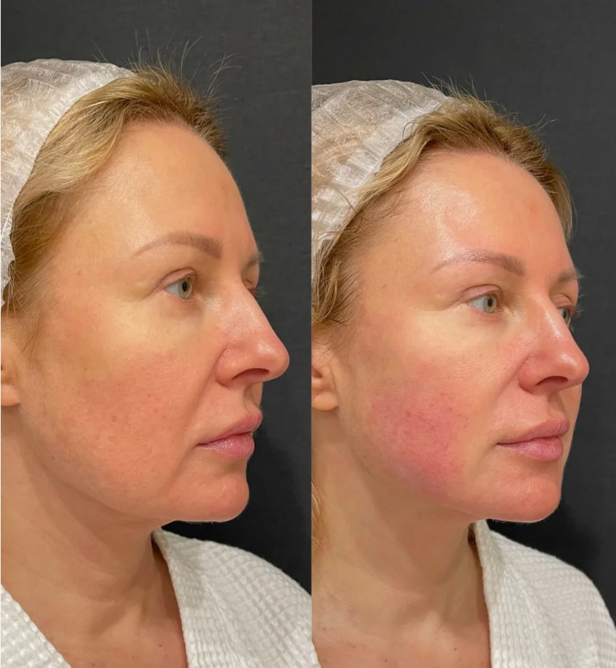 Mesotherapy-Treatments