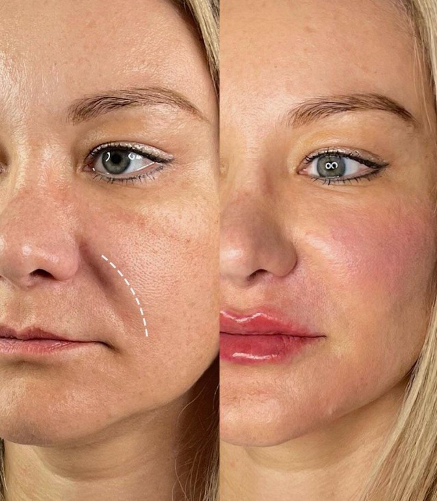 Nasolabial-Fold-Filler-Treatment
