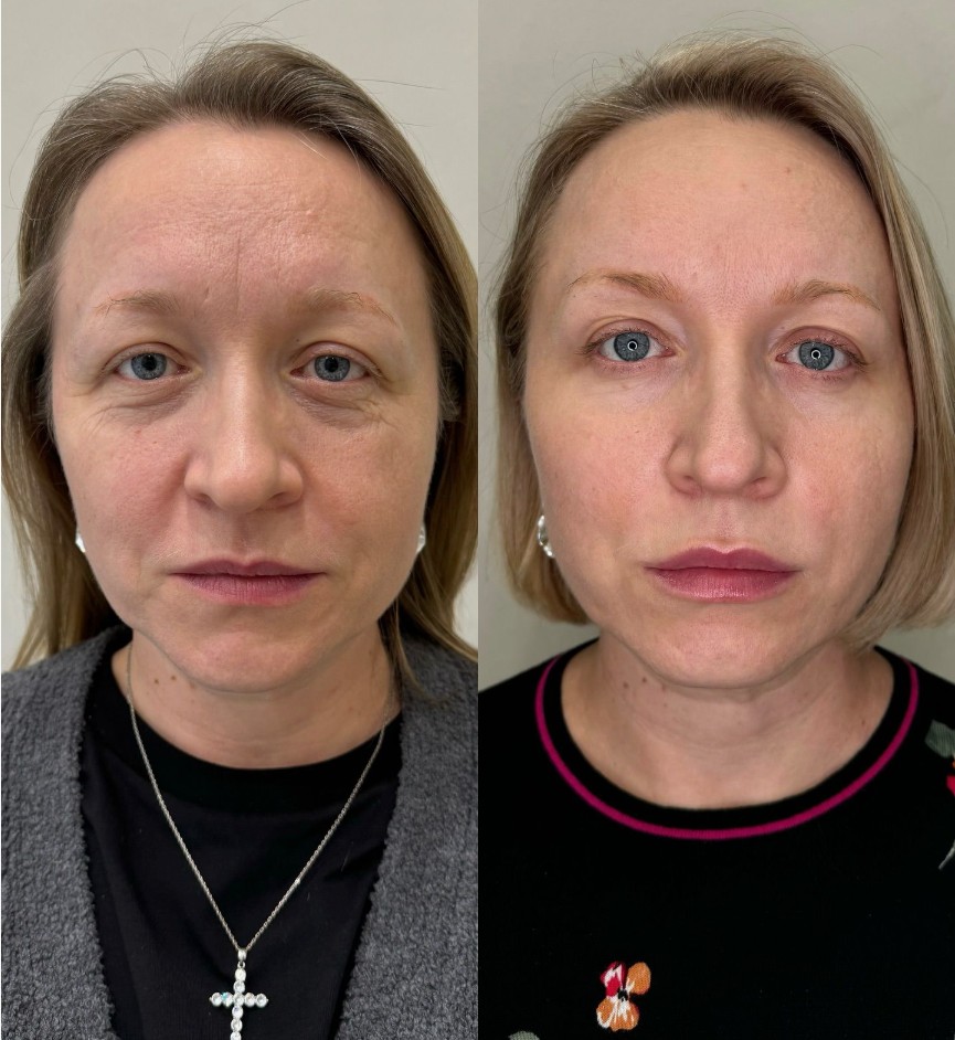 Neuramis-Filler-in-London