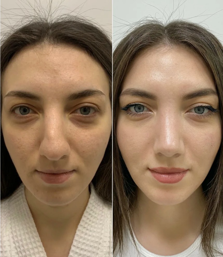 Non-Surgical-Rhinoplasty-Transform-Your-Nose-with-Expert-Care-in-London