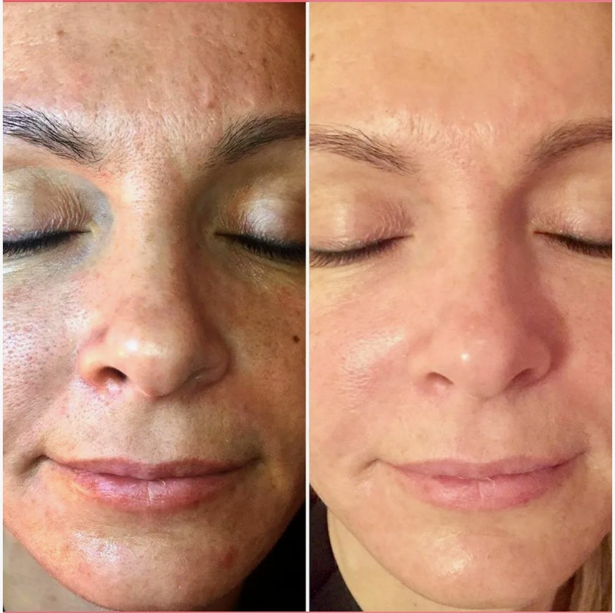 Nucleofill-Treatments