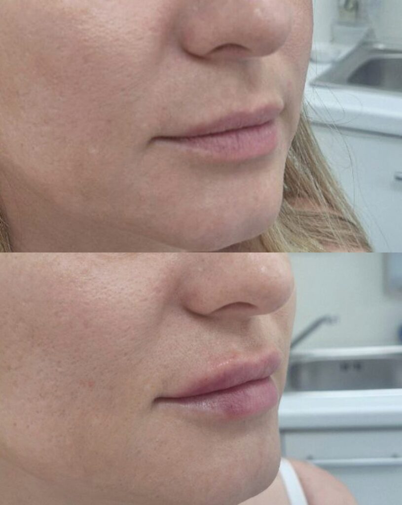 Our-Belotero-Treatment-Options-in-London