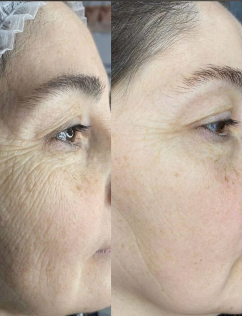 Our-Hyamax-Treatment-Options-in-London