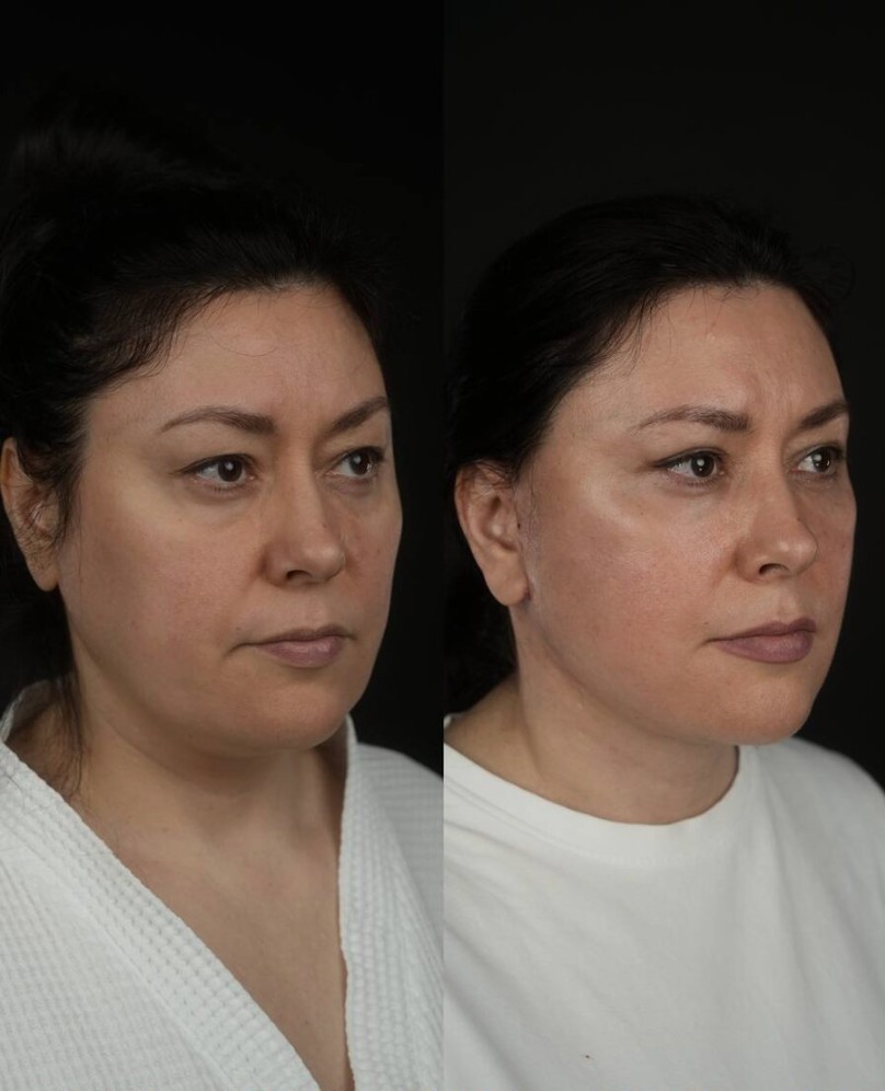 Our-Neuramis-Treatment-Options-in-London