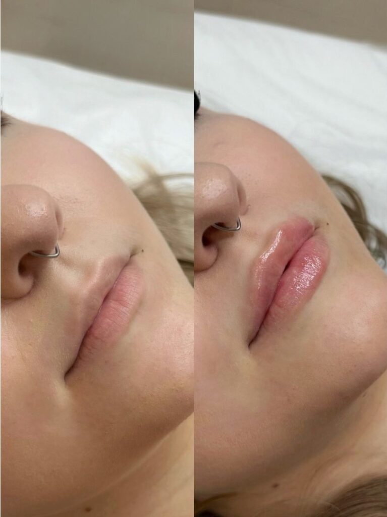 Our-Revanesse-Treatment-Options-in-London