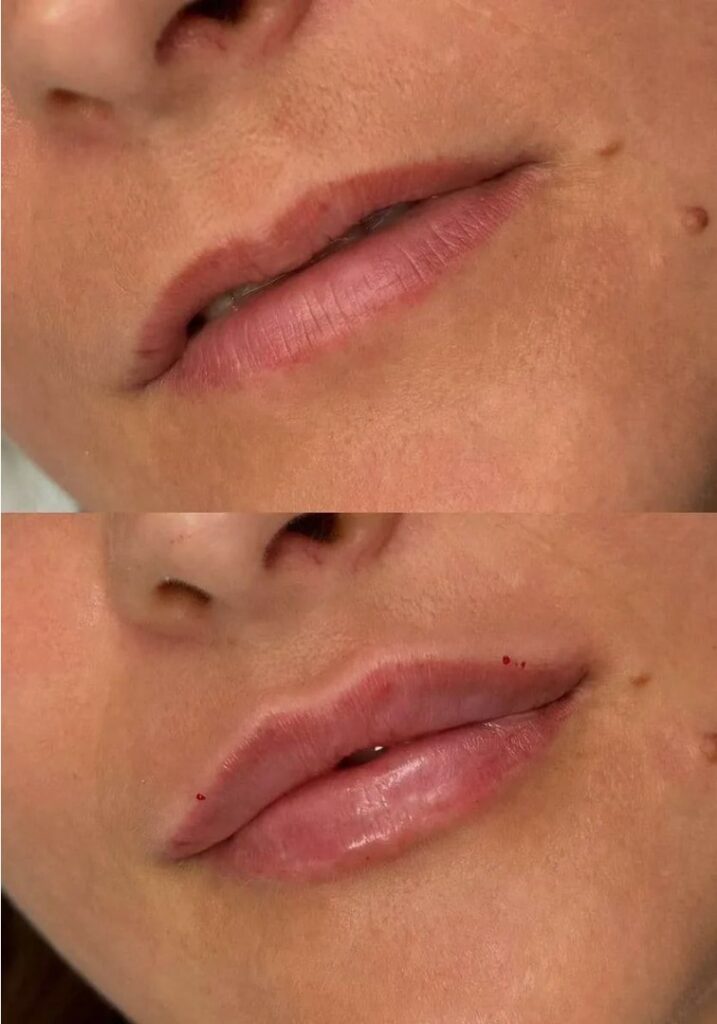 Our-Revolax-Treatment-Options-in-London