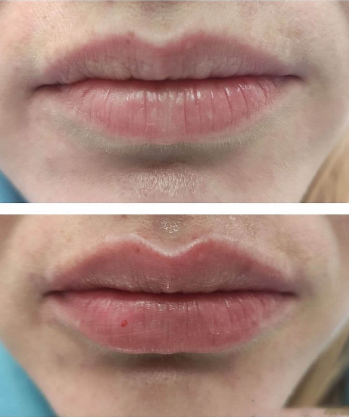 Our-Teosyal-Treatment-Options-in-London