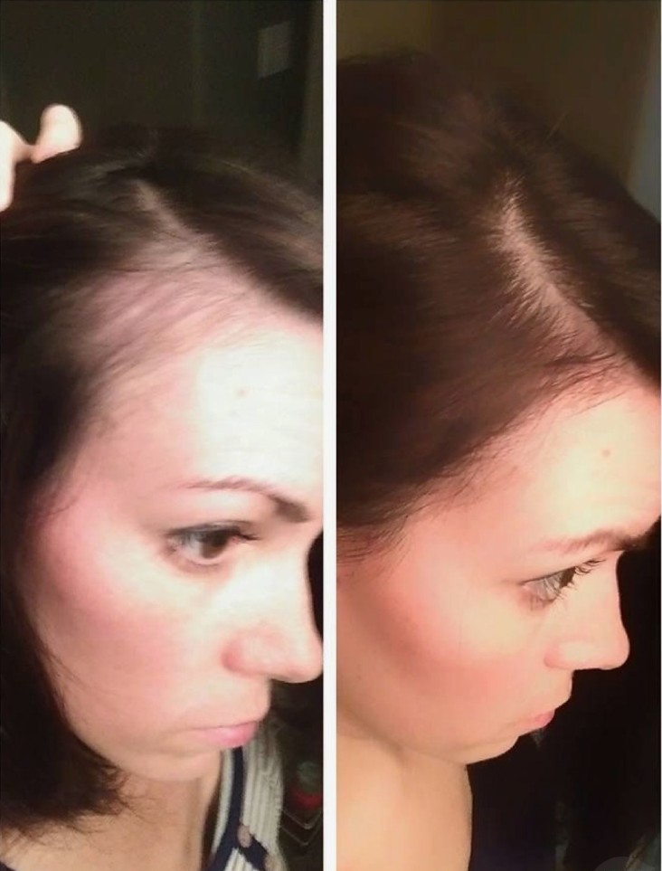 PRP-Hair-Treatment-in-London