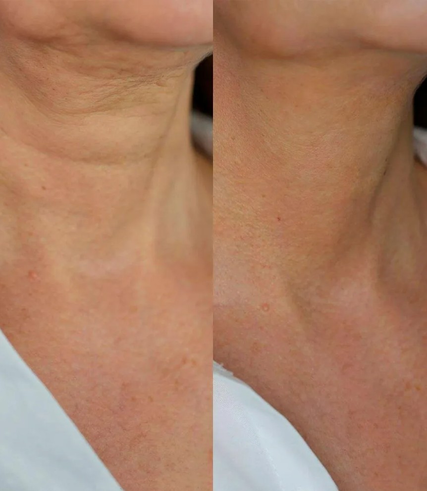 PRP-Neck-Treatments