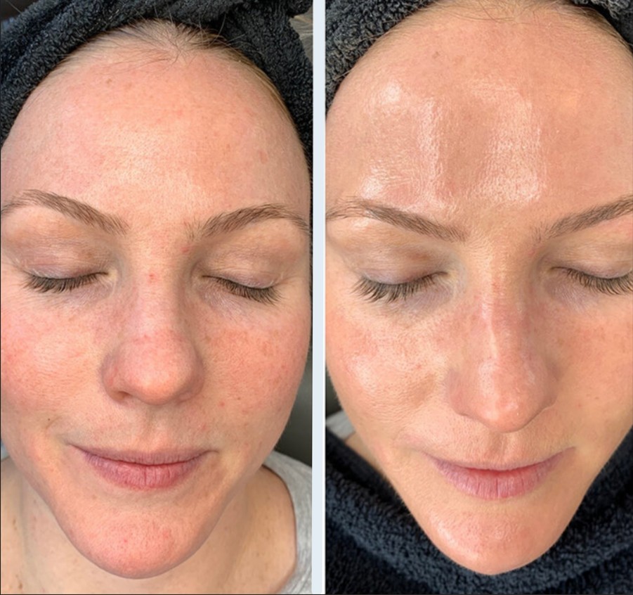 Platinum-HydraFacial