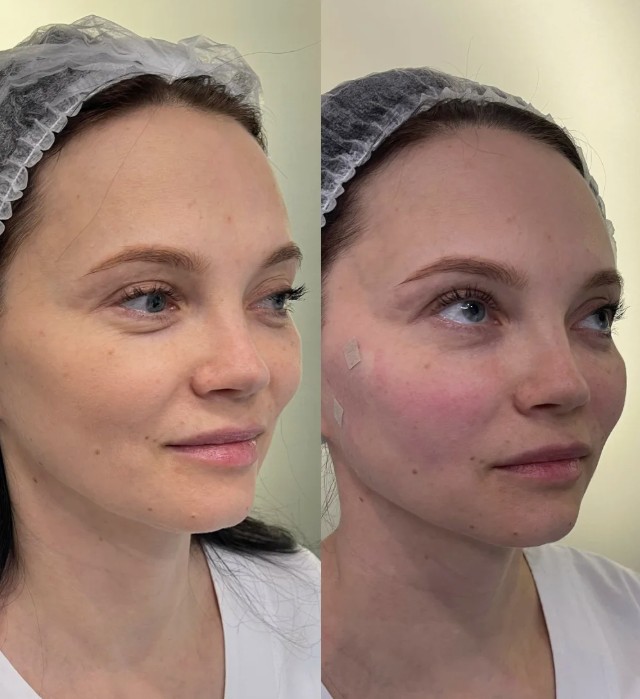 Radiesse-Filler-Treatments