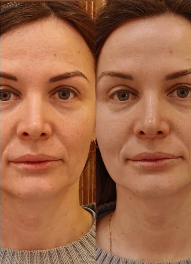 Redensity-1-Skin-Booster-in-London
