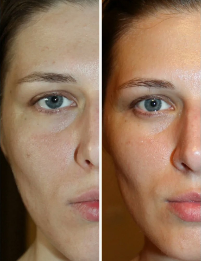 Redensity-2-Filler-in-London