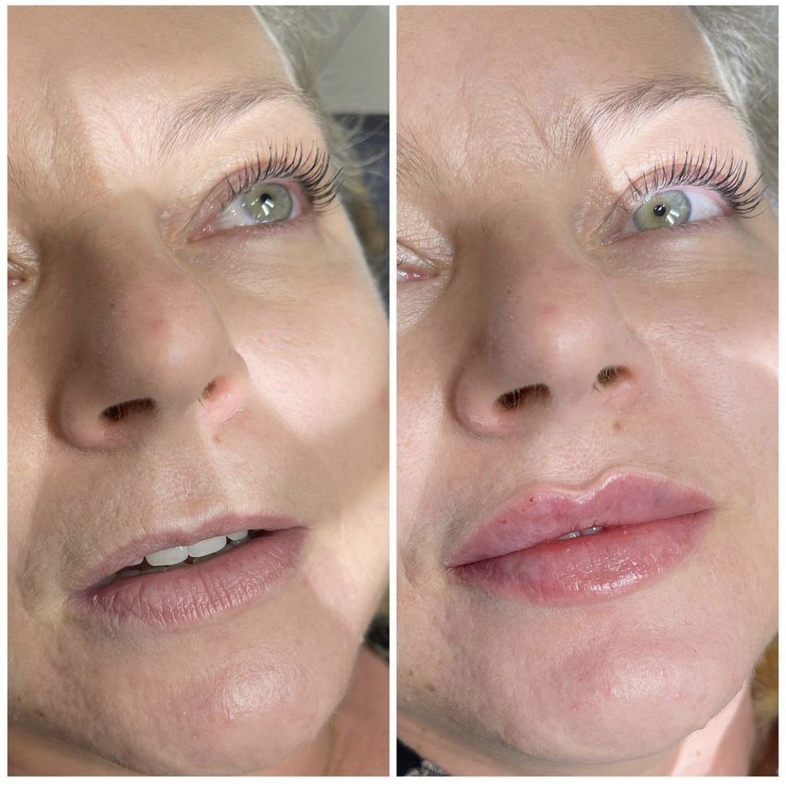 Restylane-Dermal-Filler-in-London