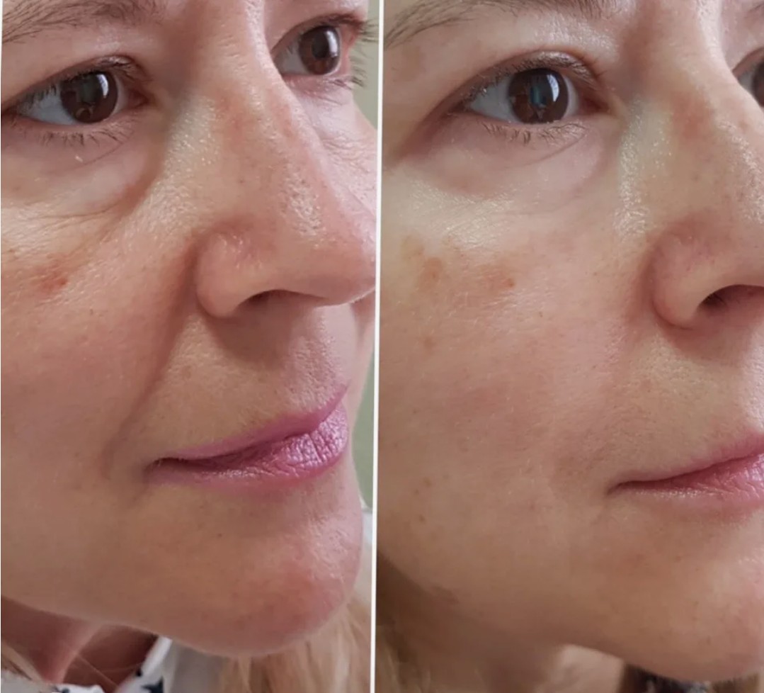 Revanesse-Filler-in-London