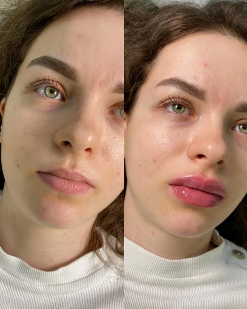 Revolax-Filler-in-London