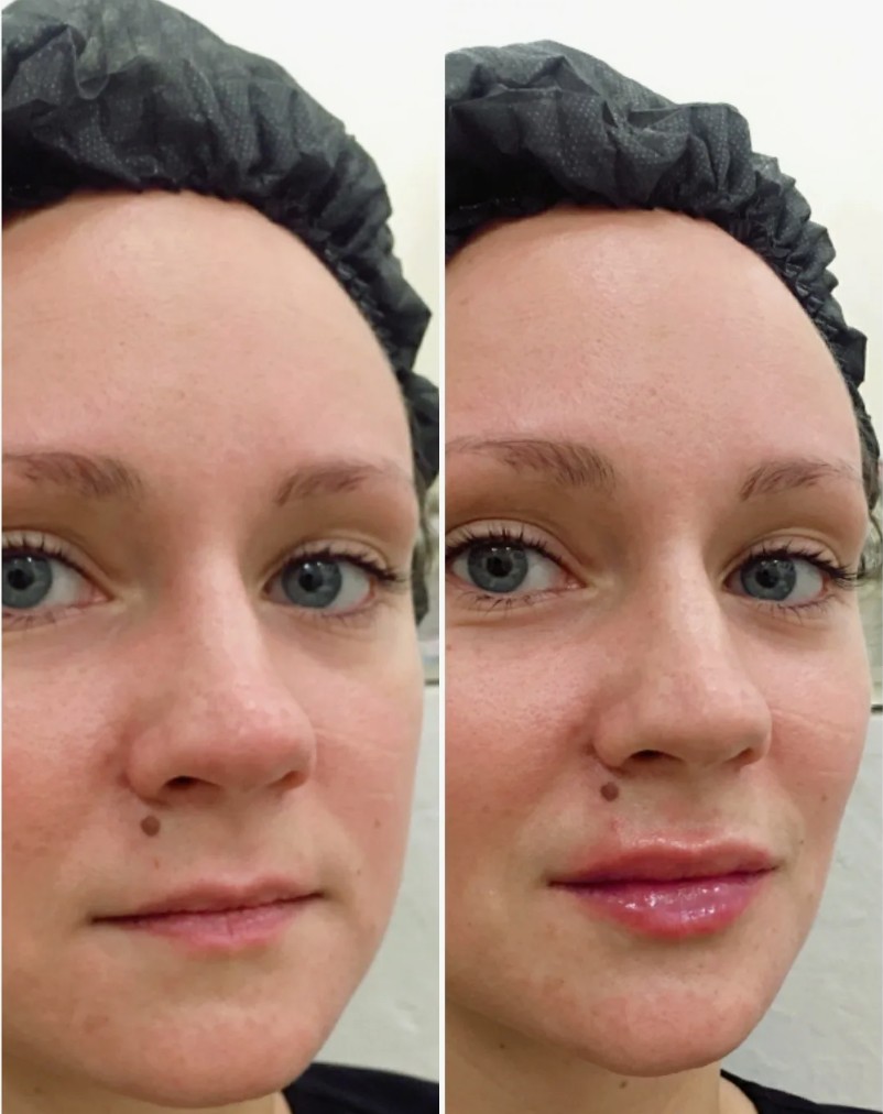 Saypha-Filler-in-London