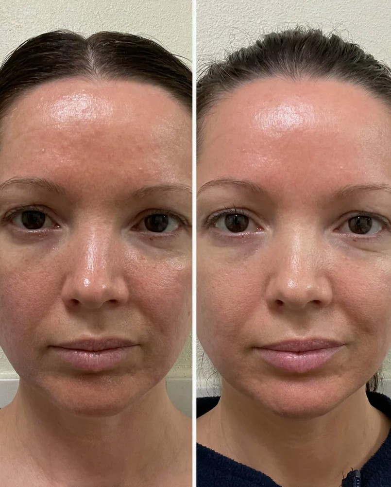 Signature-HydraFacial