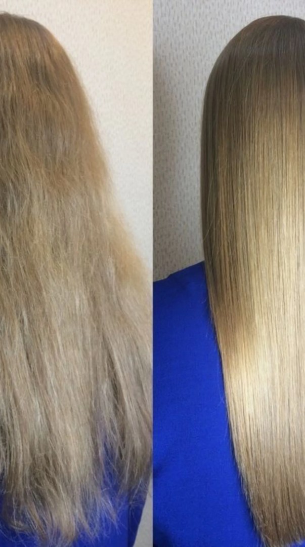 Stem-Cells-Hair-PRF-Treatments-in-London