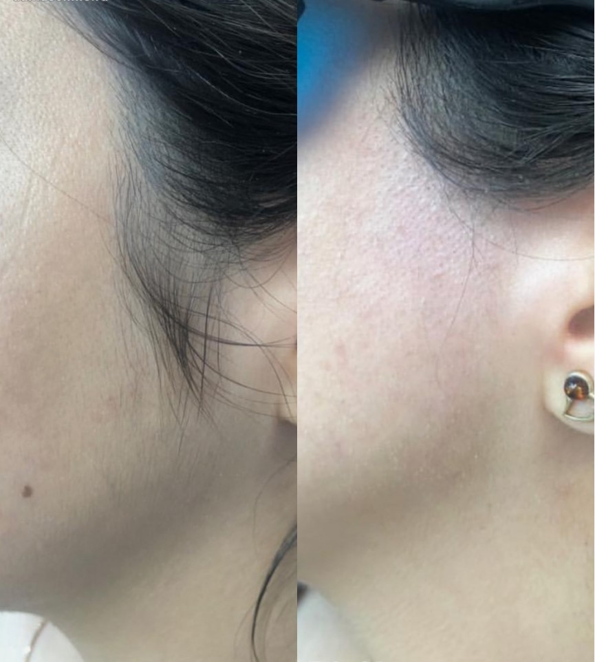 The-Facial-Laser-Hair-Removal-Process-What-to-Expect