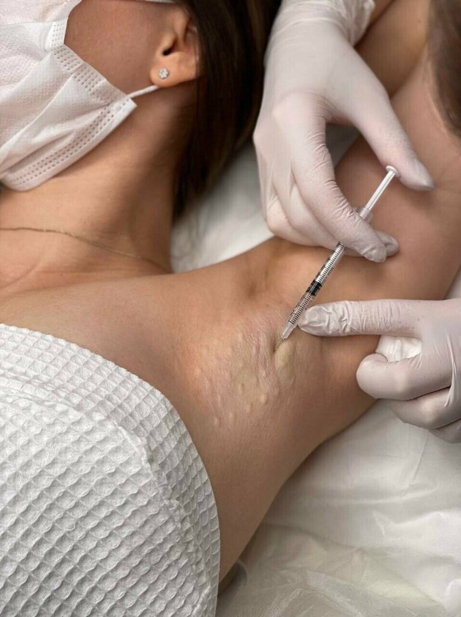 What is Botox for Hyperhidrosis