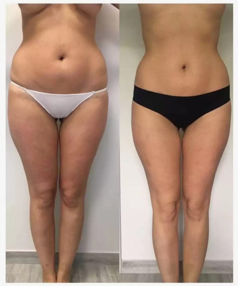 before-and-after-Forma-Body-procedure-showing-reduced-puffiness-and-smoother-skin