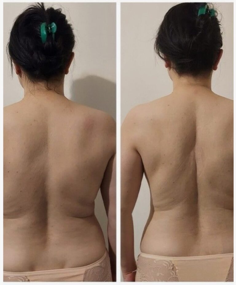 before-and-after-Forma-Body-procedure-showing-smoother-skin-and-reduced-laxity