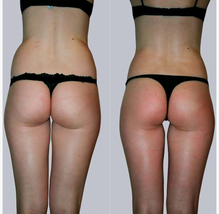 before-and-after-Forma-Body-treatment-showing-firmer-skin-and-lifted-contours