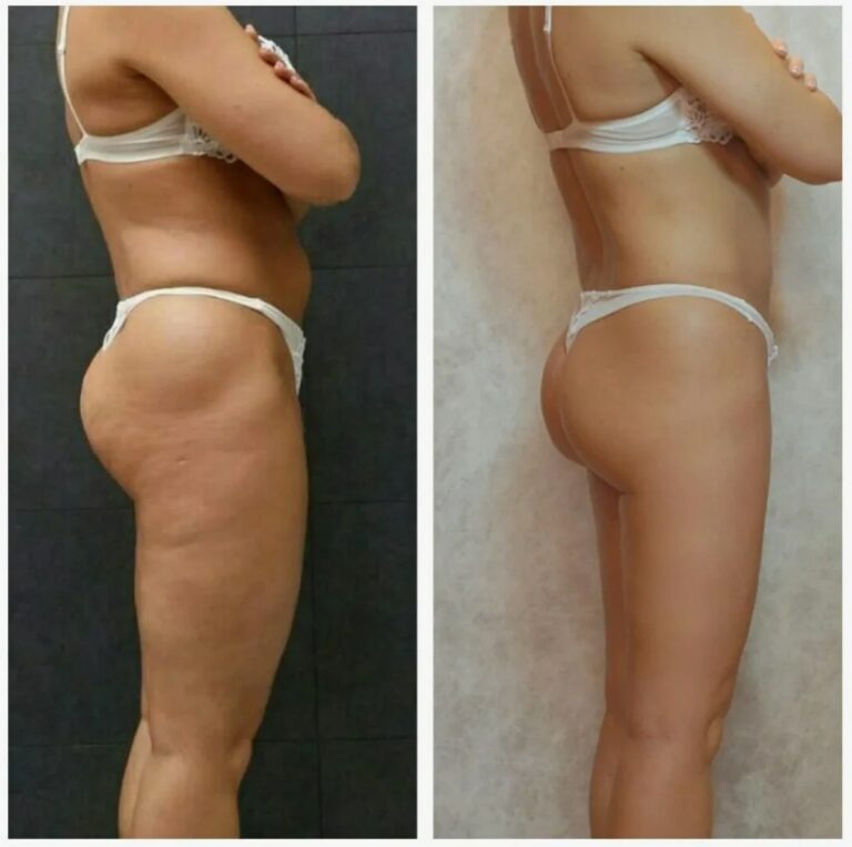 forma-body-treatment-london