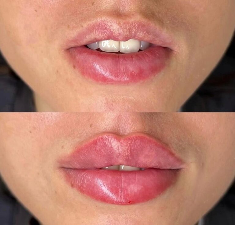 Before and after lip fillers highlighting balanced and hydrated lips