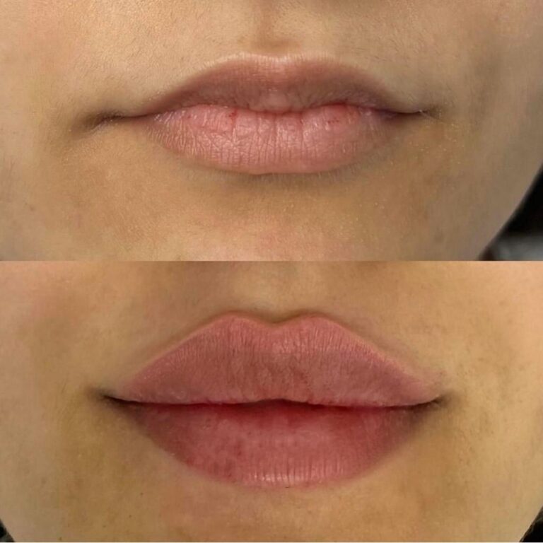 Lip filler treatment before and after photos with improved lip contour