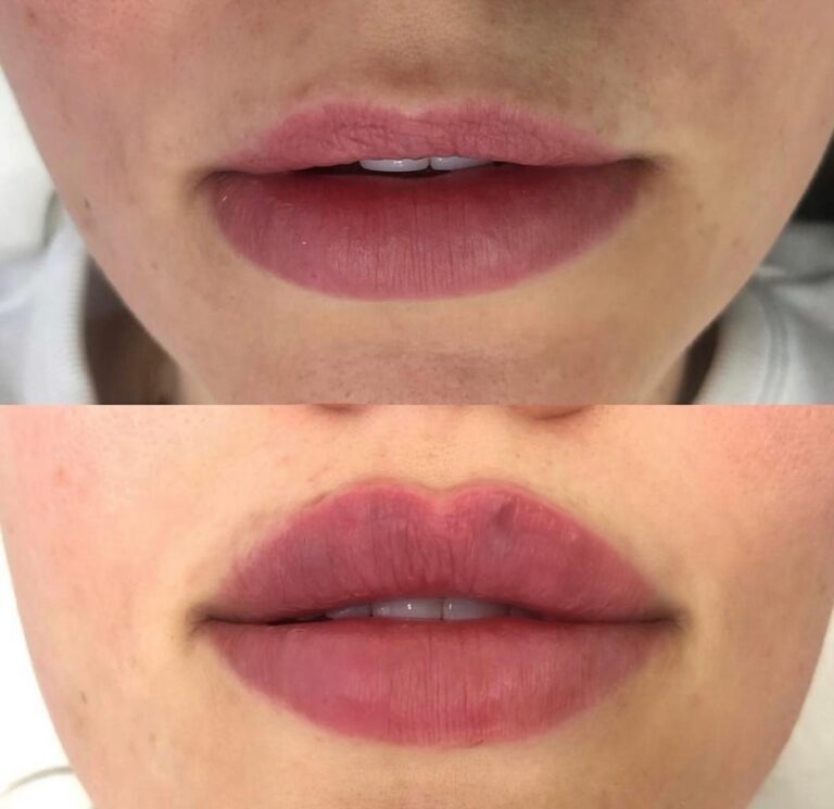 Before and after lip augmentation demonstrating natural-looking fullness