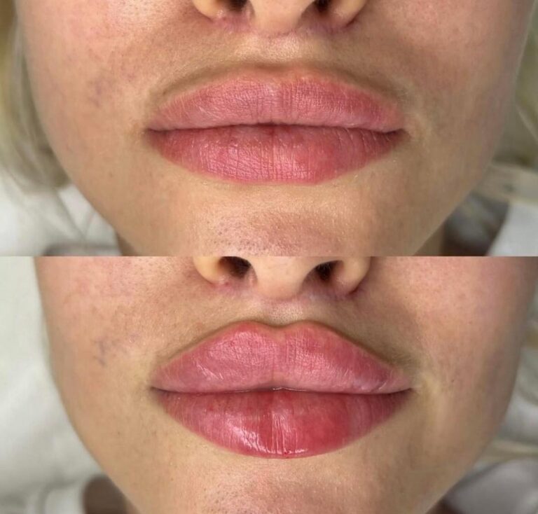 Lip filler results before and after with enhanced lip shape and definition
