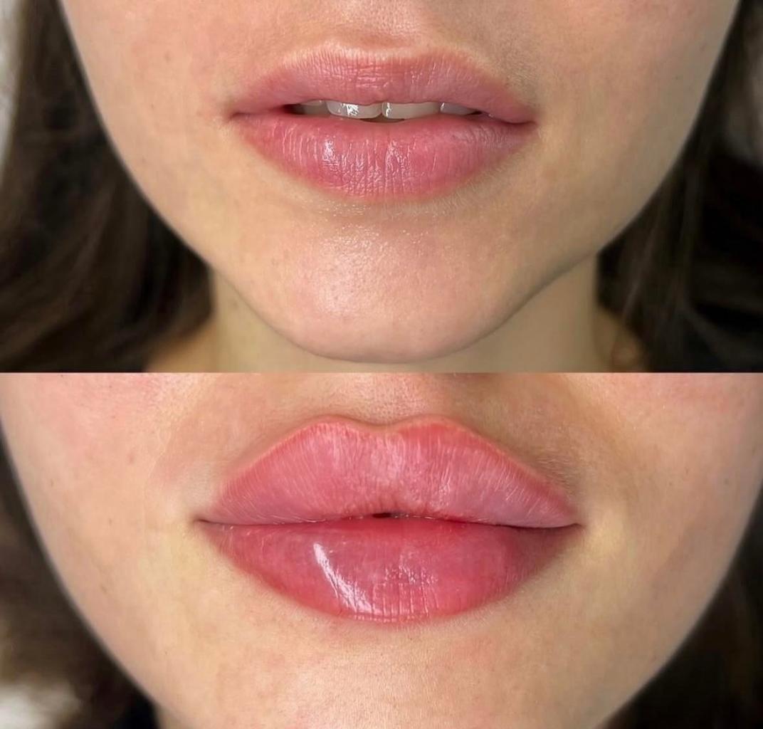 Before and after lip filler treatment showing increased lip volume