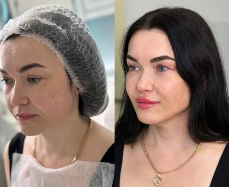 Full face fillers before and after results highlighting restored volume and balance