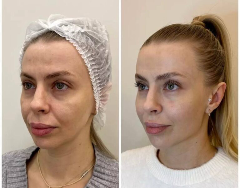 Before and after photos of full face dermal fillers demonstrating facial rejuvenation