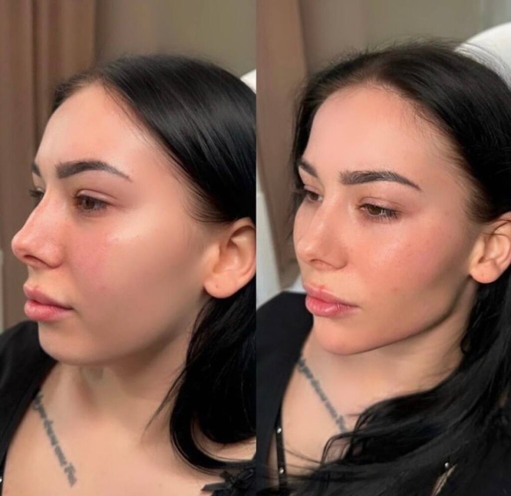 Before and after full face dermal fillers showing improved facial volume and contour