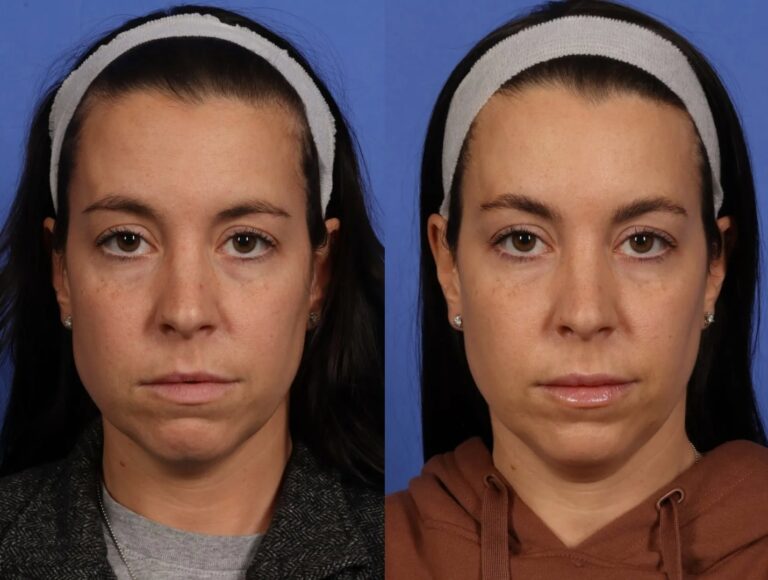 Before and after comparison showing how Botox for Jaw Slimming reduces masseter bulk.
