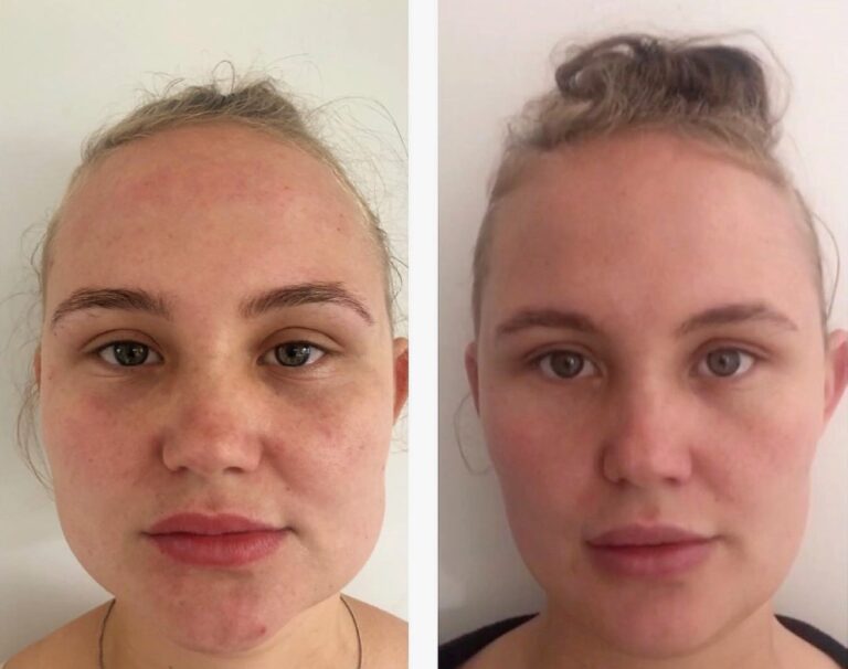 Facial contouring achieved with Botox for Jaw Slimming to refine jaw shape naturally.