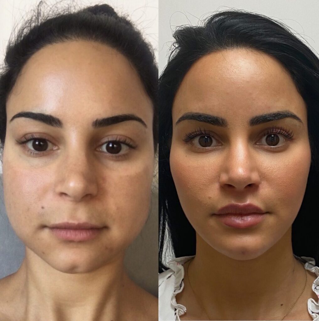 Precise injection technique used in Botox for Jaw Slimming focused on symmetry and safety.