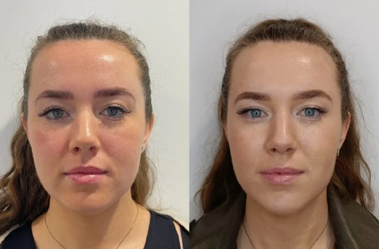 Non-surgical approach using Botox for Jaw Slimming to achieve a slimmer jawline.