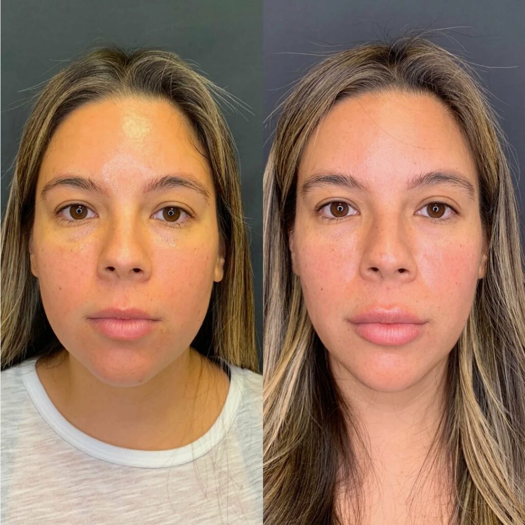 Expert-performed Botox for TMJ and Bruxism Treatments highlighting accuracy and therapeutic balance.