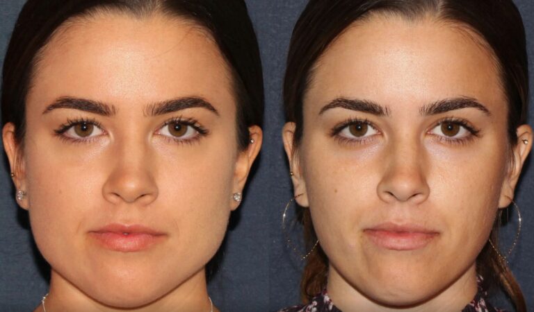 Precise injection technique used in Botox for TMJ and Bruxism Treatments focused on safety and function.